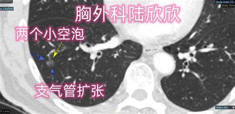 一个9毫米的早期浸润性腺癌 微医（挂号网）