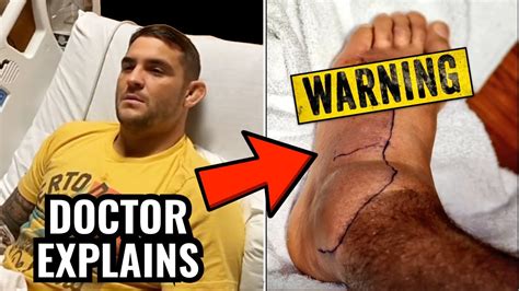 Dustin Poirier Shares Images Of Bad Foot Infection Doctor Explains