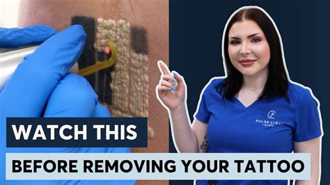 Top Clinic Expert About Tattoo Removal Youtube