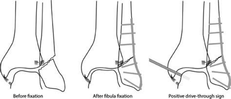 Arthroscopically Assisted Open Reduction Internal Fixation Of Ankle