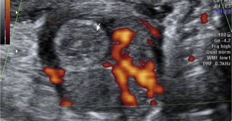 Torsion of testicular appendix ……an Ultrasound & Color Doppler ...