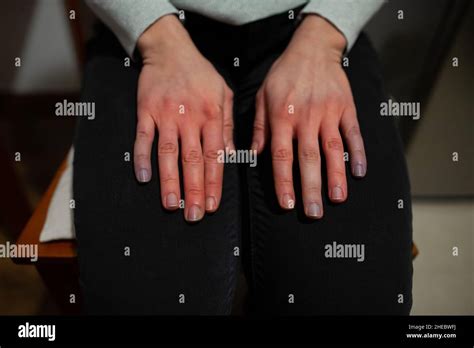 Hands of person with Raynaud syndrome on legs at home after attack ...