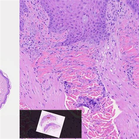 Biopsy Of The Right Arm Showing Marked Epidermal Hyperplasia Focal