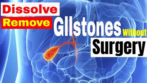 Dissolve Remove Gallstones Stone Without Surgery Home Remedies