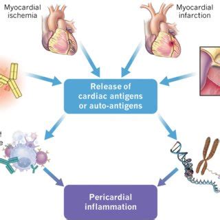 Pathophysiology Proposed Mechanism Of Pericarditis And Post Cardiac