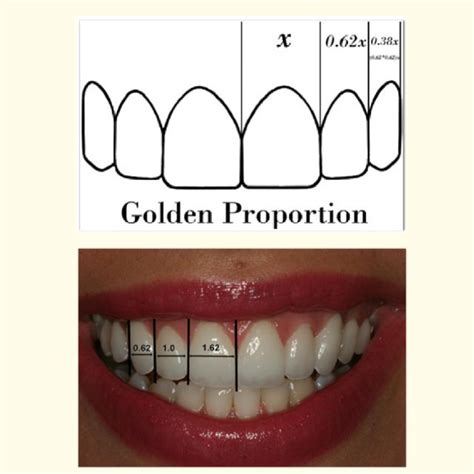 Pdf Maxillary Anterior Teeth Width Proportion A Literature Review