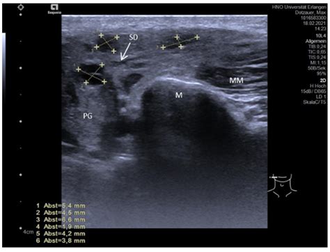 Parotid Gland Swelling Ultrasound