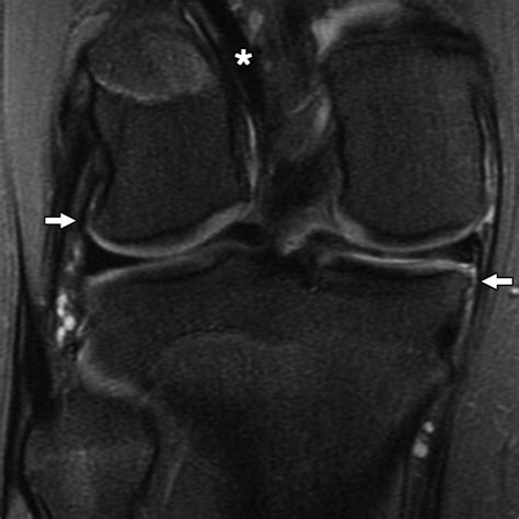 The Clinical Significance Of Osteophytes In Compartments Of The Knee Joint With Normal Articular