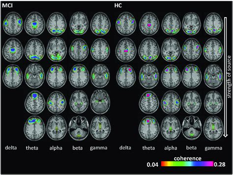 Electroencephalography Eeg Coherence Sources Results Coherence