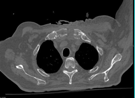 Osteomyelitis Sternum With Abscess Chest Case Studies Ctisus Ct