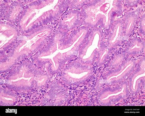 Nonatypical Endometrial Hyperplasia Light Micrograph Stock Photo Alamy