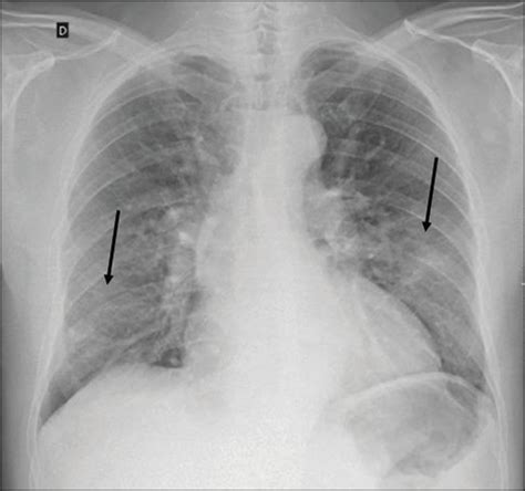 SciELO Brasil COVID 19 A Brief Update For Radiologists COVID 19 A