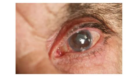 Causes Symptoms And Treatment Options For Cataracts Obn