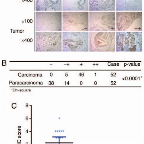 Mtmr Protein Expression In Breast Cancer Tissues And Adjacent