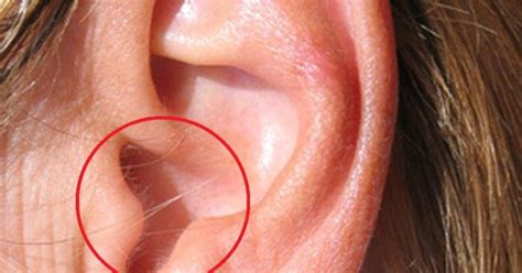 Having Hair In Your Ear Is A Warning Sign Ear Wax Removal Tinnitus