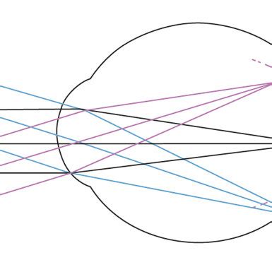 Peripheral Hyperopic Defocus Red Arrow Might Lead To Axial