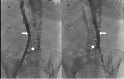 Venogram Depicting Patients Duplicated Ivc Anatomy Image On The Left