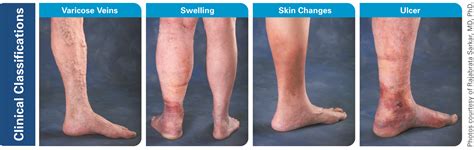 Vein Disease Symptoms Cvd Vein