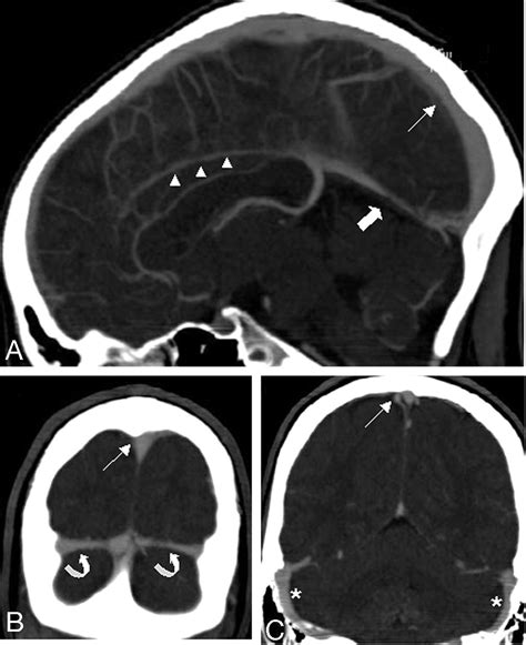 Inferior Sagittal Sinus Mri