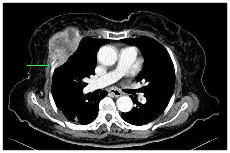 A Contrast Enhanced Computed Tomography Scan Of The Chest Axial