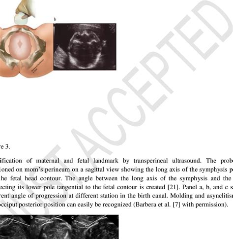 Fetal head position during the entire labor. Diagnosis made by ...