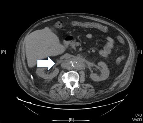 Non Contrast Ct Of The Abdomen And Pelvis Showing Mural Aortic Download Scientific Diagram