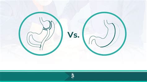 Gastric Sleeve Vs Bypass Key Differences Dr Santiago Gomez Correa I