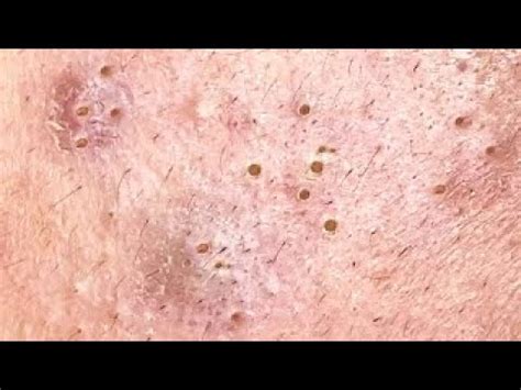 Relaxing Make Your Acne Treatment Sac Dep Spa 290 Blackheads