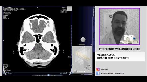 Tomografia De Cr Nio Sem Contraste Passo A Passo Tomografia