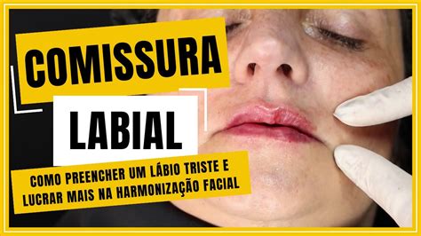 Desvio Da Comissura Labial - Desvio Da Comissura Labial - RETOEDU