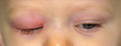 Periorbital Cellulitis Infant