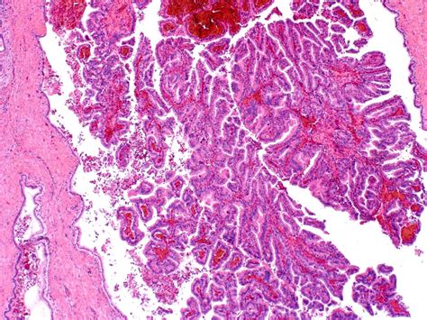 Pathology Outlines Intraductal Papillary Neoplasm Of The Bile Ducts