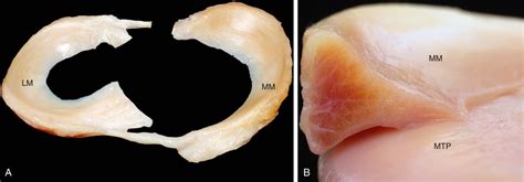 Meniscal Pathology Meniscus Anatomy Musculoskeletal Key