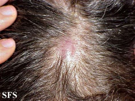 Follicular lymphoma physical examination - wikidoc