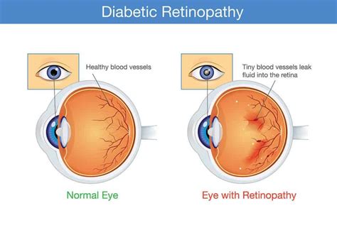 Diabetic Retinopathy Causes And Treatments Chelvin Sng Eye Center