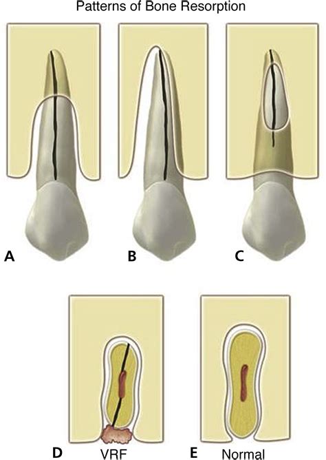 Vertical Root Fracture The Journal Of The American Dental Association