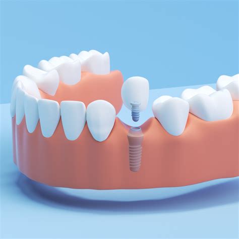 Dental Implants Single Tooth Implant Aspen Dental