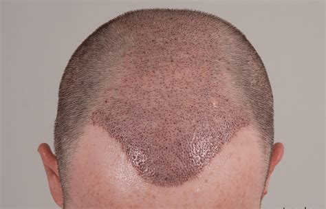 How To Remove Scabs After A Hair Transplant Regrow