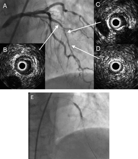 Coronary Aneurysm Associated With Coronary Perforation After Sirolimus