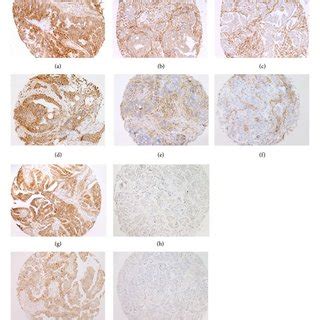 Representative Examples Of Hla Immunohistochemical Staining Hla A