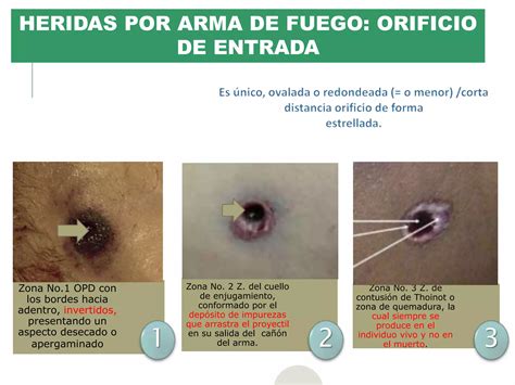 Heridas Por Arma De Fuego PPT