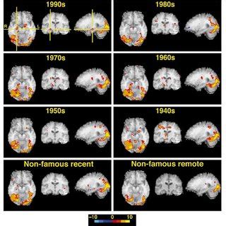 Functional Magnetic Resonance Imaging Fmri Activation From The Famous