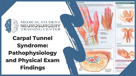 Carpal Tunnel Syndrome Pathophysiology And Physical Exam Findings