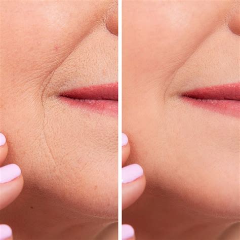 Juvéderm Vollure XC Dermal Fillers in Santa Rosa and Healdsburg