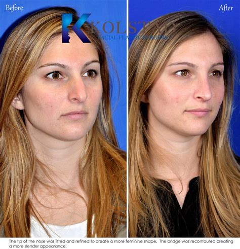 Rhinoplasty Before & After Gallery | Dr. Kolstad - San Diego Facial Plastic Surgeon