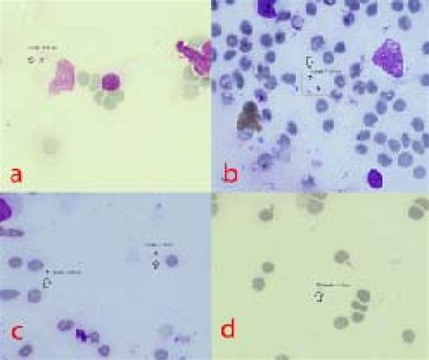 Pathognomonic Leishmania Bodies On The Smear X1000 Magnification