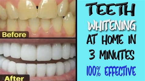 Teeth Whitening At Home In 3 Minutes How To Whiten Yellow Teeth To White Naturally Youtube