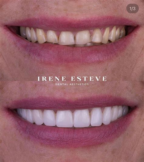 Carillas Y Bruxismo Son Compatibles Irene Esteve Dental Aesthetics