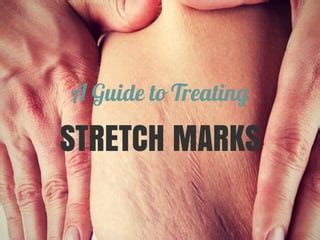 Guide To Treating Stretch Marks PPT