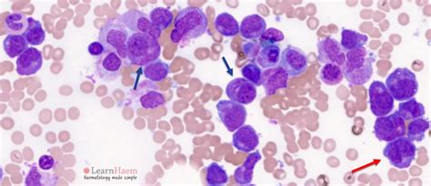 Acute Promyelocytic Leukaemia APML LearnHaem Haematology Made Simple